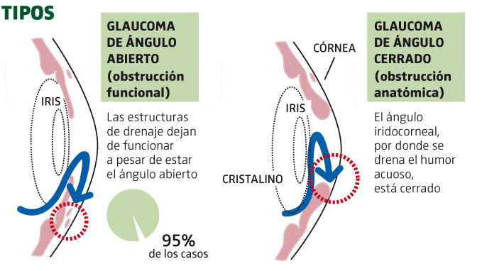 Infograf A La Prevenci N Del Glaucoma Imo
